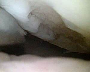 Foto van kapot kraakbeen